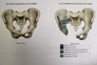 Аутокость и 3D-импланты. Специалисты Онкоцентра творят чудеса при  реконструкции поражённых опухолью костей таза.. ФГБУ «НМИЦ онкологии им.  Н.Н. Блохина» Минздрава России