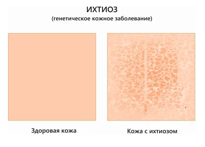 Микоз кожи стоп, ногтей, головы, рук | Лечение микоза у ребенка и взрослого  в Клинике подологии Полёт в Москве