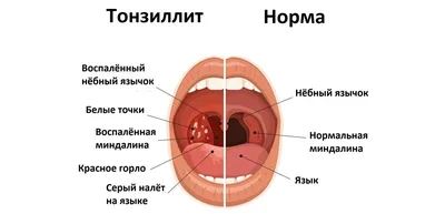 Красное горло у грудничка — симптомы и лечение состояния — клиника  «Добробут»