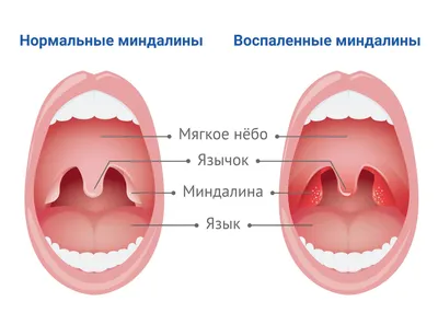 Почему болит горло и нёбо, что делать