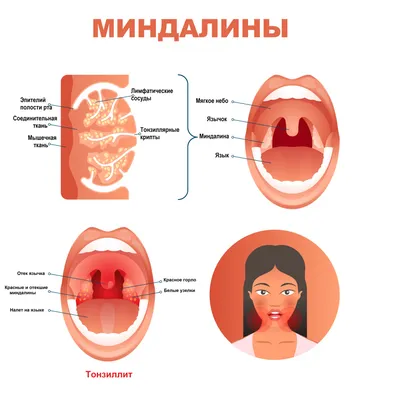 Ангина у ребенка: вирусная, грибковая, фолликулярная, катаральная симптомы  и лечение