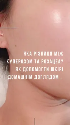 Что можно и нельзя при куперозе на лице