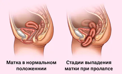 Лабиопластика – это пластическая операция по коррекции размера и формы  больших и малых половых губ. Чаще всего ее проводят, потому что… | Instagram