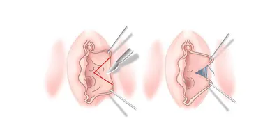 Лабиопластика- коррекция визуальной формы, объема, строения малых и/или  больших половых губ, устранение нарушений строения после… | Instagram