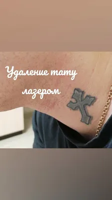 Фото лазерного удаления татуировки в ближнем плане