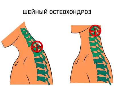 Остеохондроз грудного отдела позвоночника - симптомы и лечение