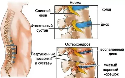 Гимнастика при остеохондрозе грудного отдела | Блог о здоровье