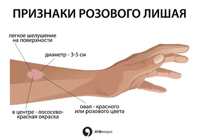 Лечение розового лишая (лишая Жибера) в Киеве — Derma.ua