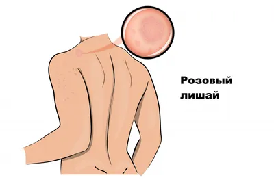 Розовый лишай: причины, симптомы, терапия - MedicalAdvice.ru