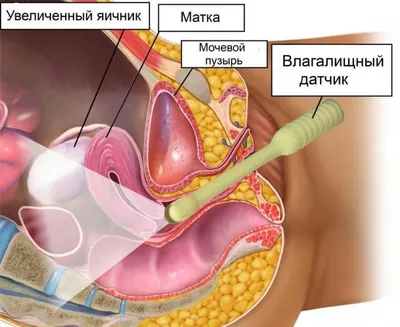 Эпизиотомия при родах - «☆ Эпизитомия - для ленивых врачей! Мои 2 родов -  первые с эпизо и вторые - без. Возвращение в \"большой секс\" после. Мой  разрез спустя 6 лет ☆» | отзывы