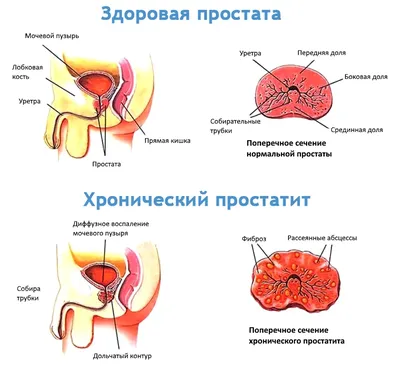 Последствия хронического простатита для мужчин