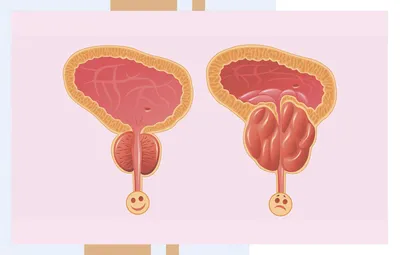 Профилактика простатита и аденомы простаты у мужчин