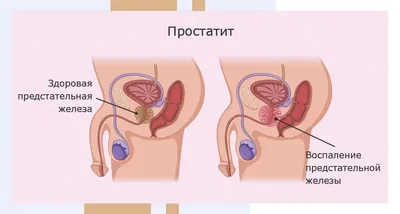 Профилактика простатита и аденомы простаты у мужчин