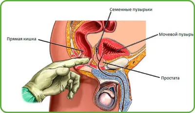 Зачем делать массаж простаты? Ответ докмед уролога | Пикабу