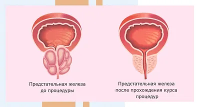 Массаж простаты в Москве: цены на лечебный массаж простаты в клинике  АльтраВита