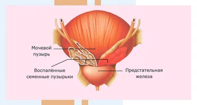 Жжение в простате и заднем проходе: в чём может быть причина и как от этого  избавиться