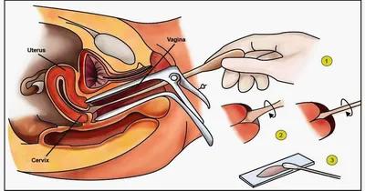 Гинекологический мазок из цервикального канала | Медицина Люкс