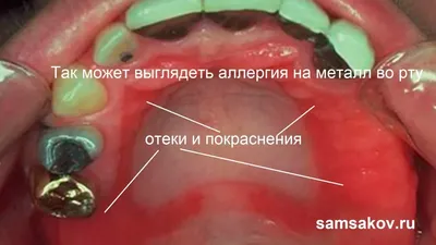 Жидкий металл с доставкой по всей России от производителя