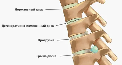 Гимнастика, ЛФК и комплекс лечебных упражнений при сколиозе