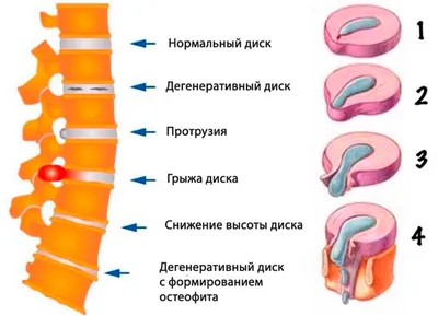 Остеохондроз грудного отдела позвоночника - симптомы и лечение