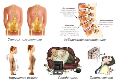 Комплекс упражнений ЛФК при сколиозе