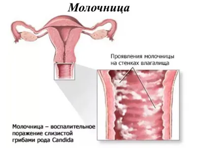 Молочница - признаки, причины, симптомы, лечение и профилактика - iDoctor.kz