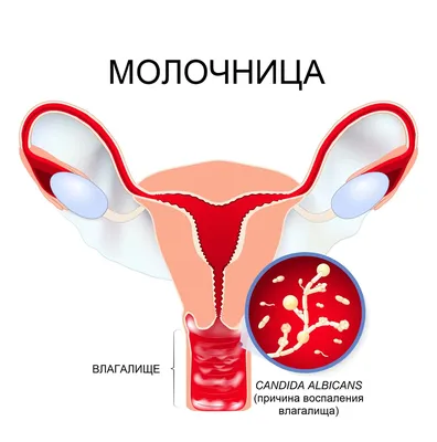 Молочница - причины заболевания, симптомы и лечение