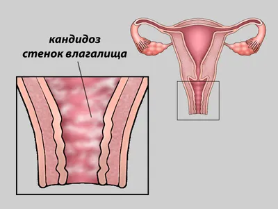 ➡️ Кандидоз (молочница), симптомы и лечение, причины заболевания у мужчин и  женщин - клиника Девита (Devita)