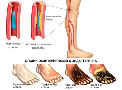 Облитерирующий эндартериит картинки фотографии