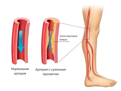 Облитерирующий эндартериит | Санаторий Боржава