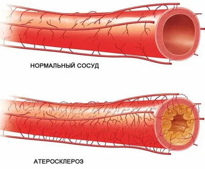 Облитерирующий эндартериит