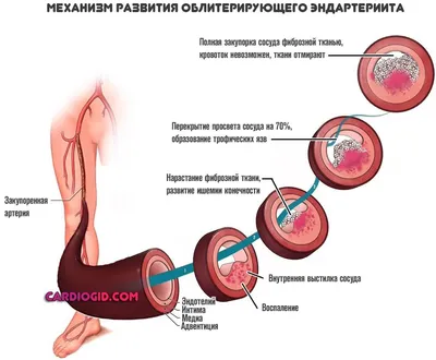 Облитерирующий эндартериит. Курить или ногу потерять? | by Уголок Доктора  (Armen Astvatsatryan) | Medium