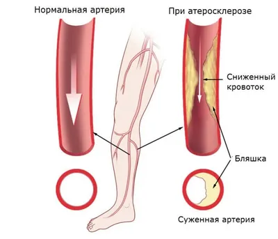 Атеросклероз нижних конечностей – облитерирующий и хронический - причина  онемения ног.