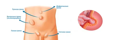 КАК ПОМОЧЬ СЕБЕ ПРИ ОПУЩЕНИИ ВНУТРЕННИХ ОРГАНОВ?/ Животам НЕТ! // Владимир  Животов - YouTube