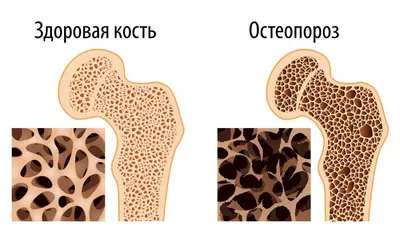 Остеопороз - тихая эпидемия - симптомы, причины, методы лечения в МЦ  \"Звезда\"