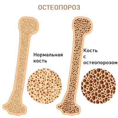 Остеопороз — ГБУЗ \"Пензенская областная станция скорой медицинской помощи\"