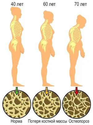 Остеопороз - причины развития заболевания, симптомы, диагностика и лечение