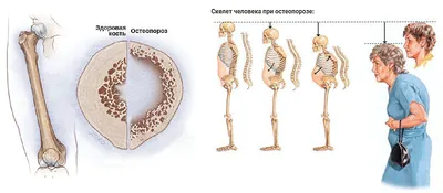 Остеопороз | Статьи «Омнифарм»