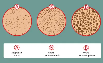 Что такое остеопороз и как его предотвратить? | Блог | Complimed