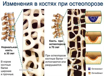 Неделя профилактики остеопороза