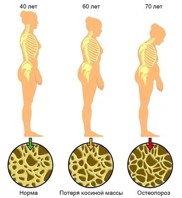 Что такое остеопороз - ослабление костей и его причины