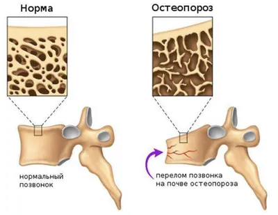 Остеопороз: причины, симптомы, лечение