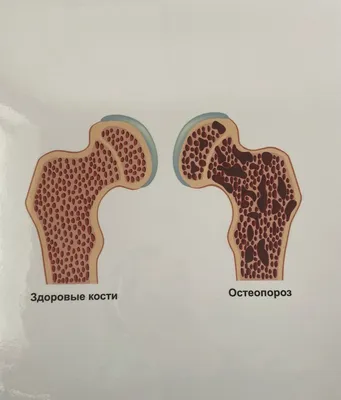 Менопаузальный остеопороз - диагностика, причины, лечение в многопрофильной  клинике UNICLINICA