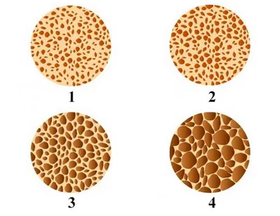 Blog | Лечение остеопороза