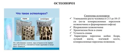 Остеопороз