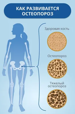 Остеопороз у женщин: методы, способы и средства лечения остеопороза