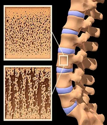 Остеопороз и его симптомы, что это за болезнь и как ее лечить женщинам