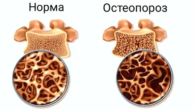Остеопороз: рекомендации по профилактике — Медицинский центр «Целитель»