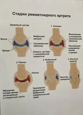 Клиника Фенарета - Остеопороз