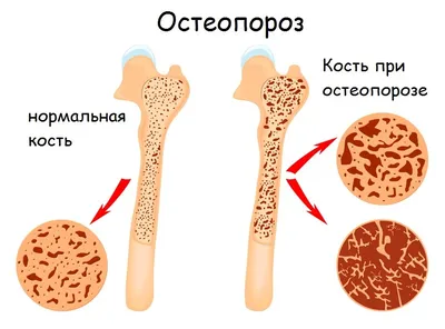 Остеопороз костей - симптомы и причины, профилактика заболевания.